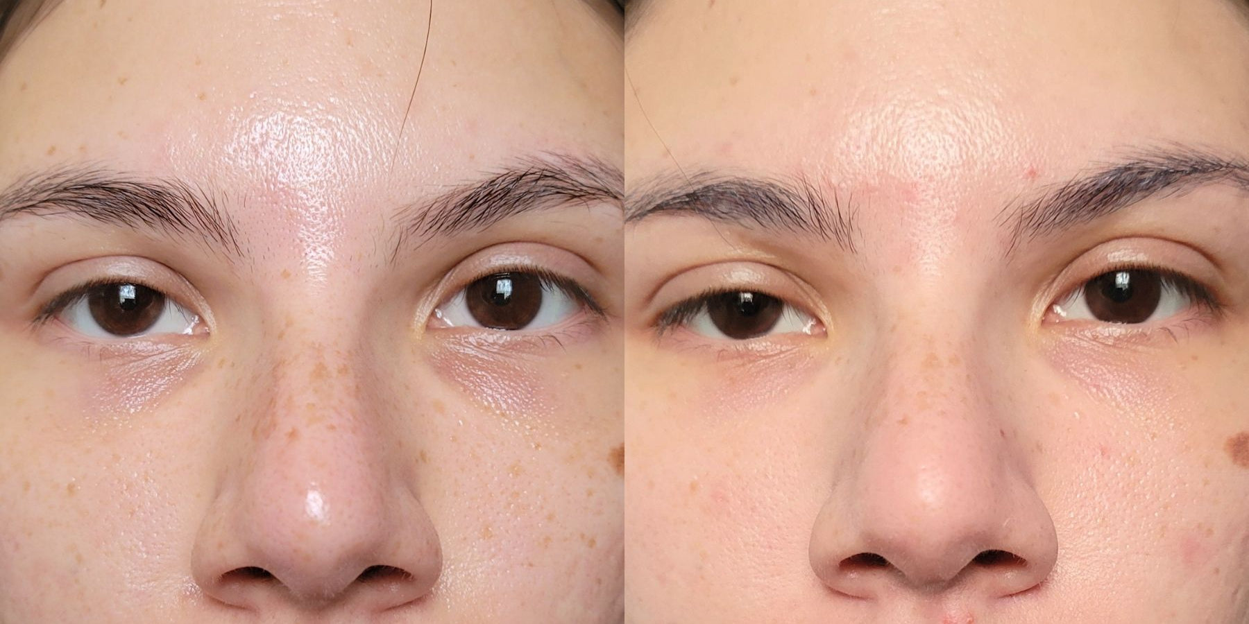 how to get rid of dark circles