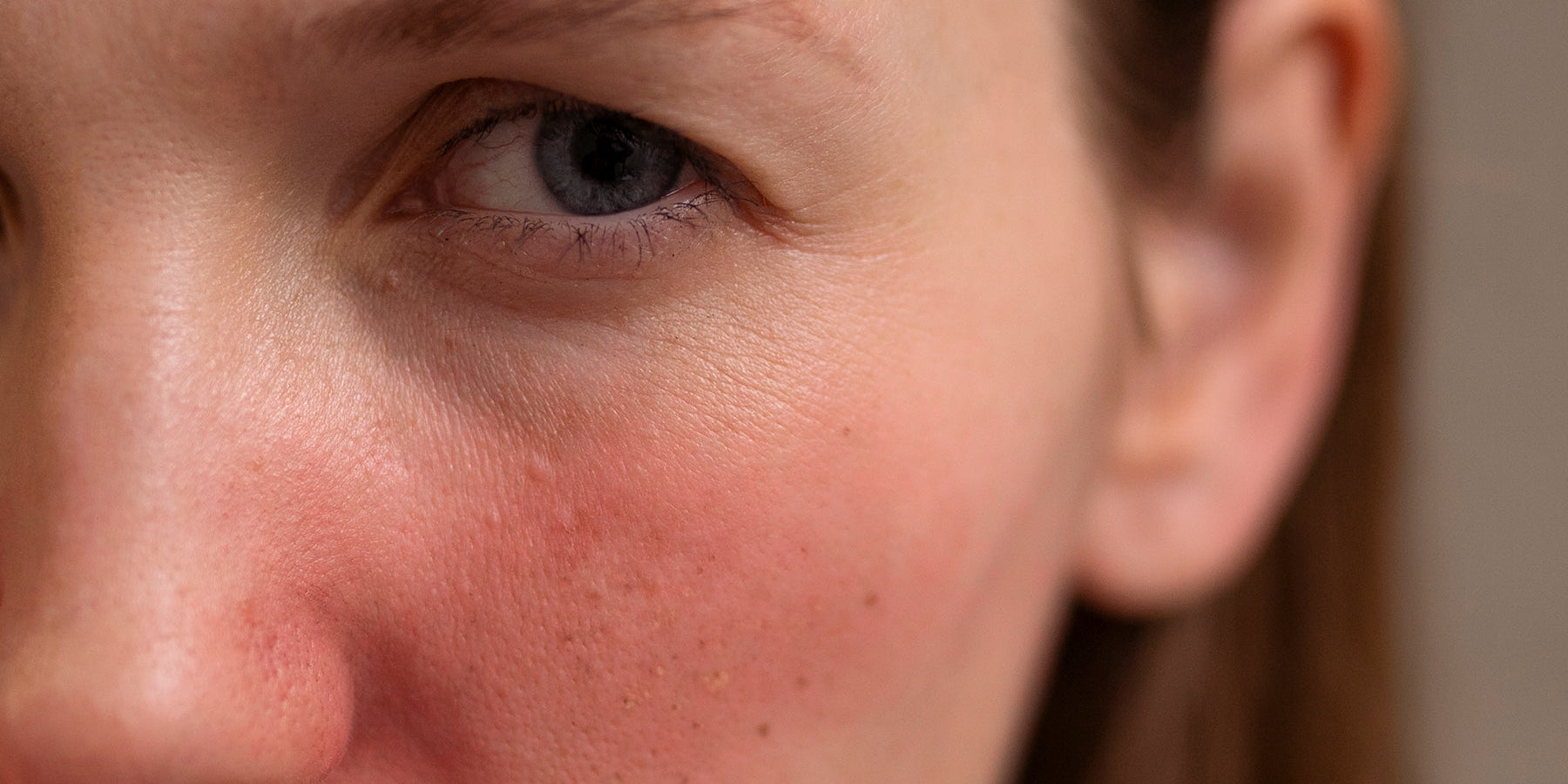 Inflammation: The Invisible Culprit Behind Your Skin Issues