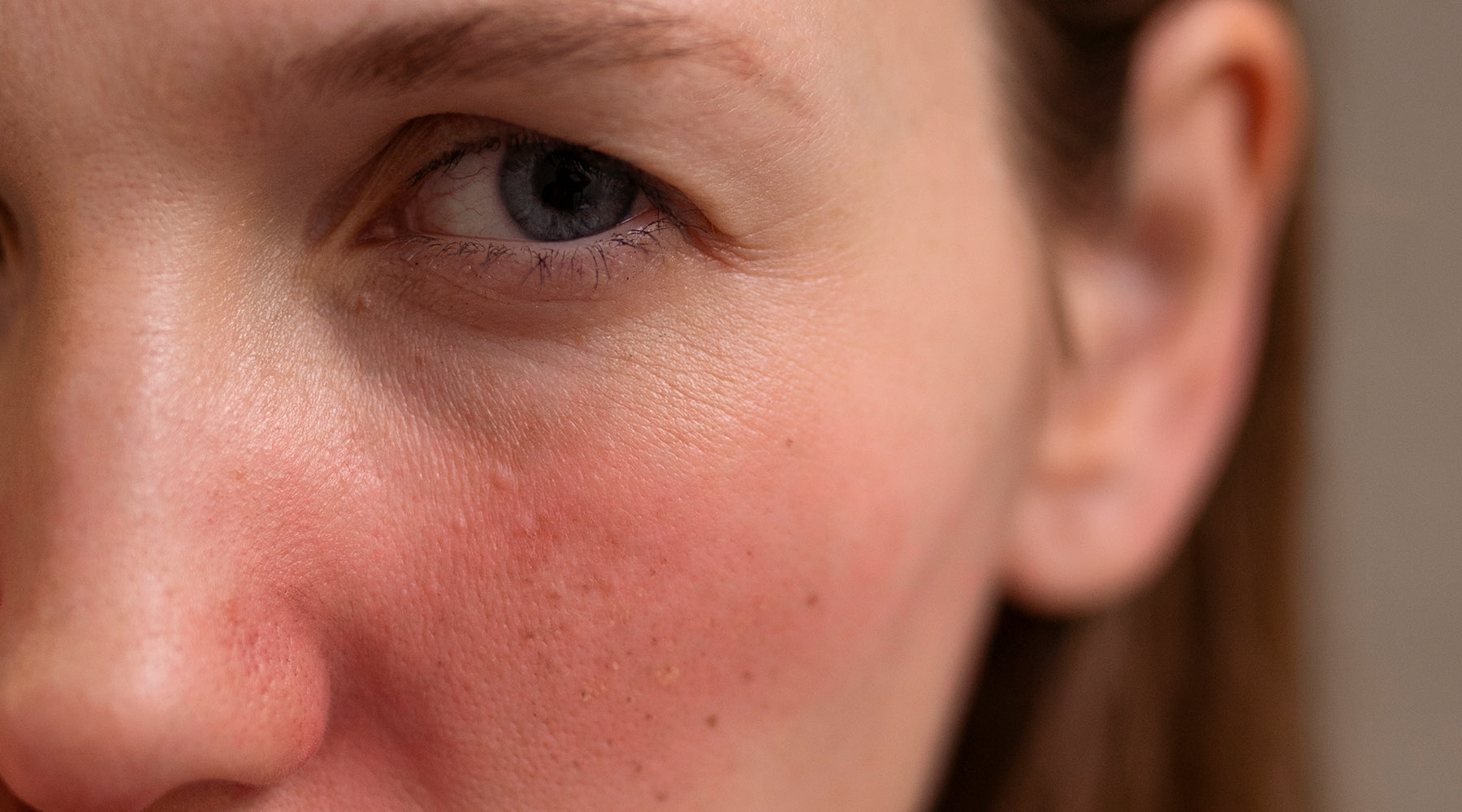 Inflammation: The Invisible Culprit Behind Your Skin Issues