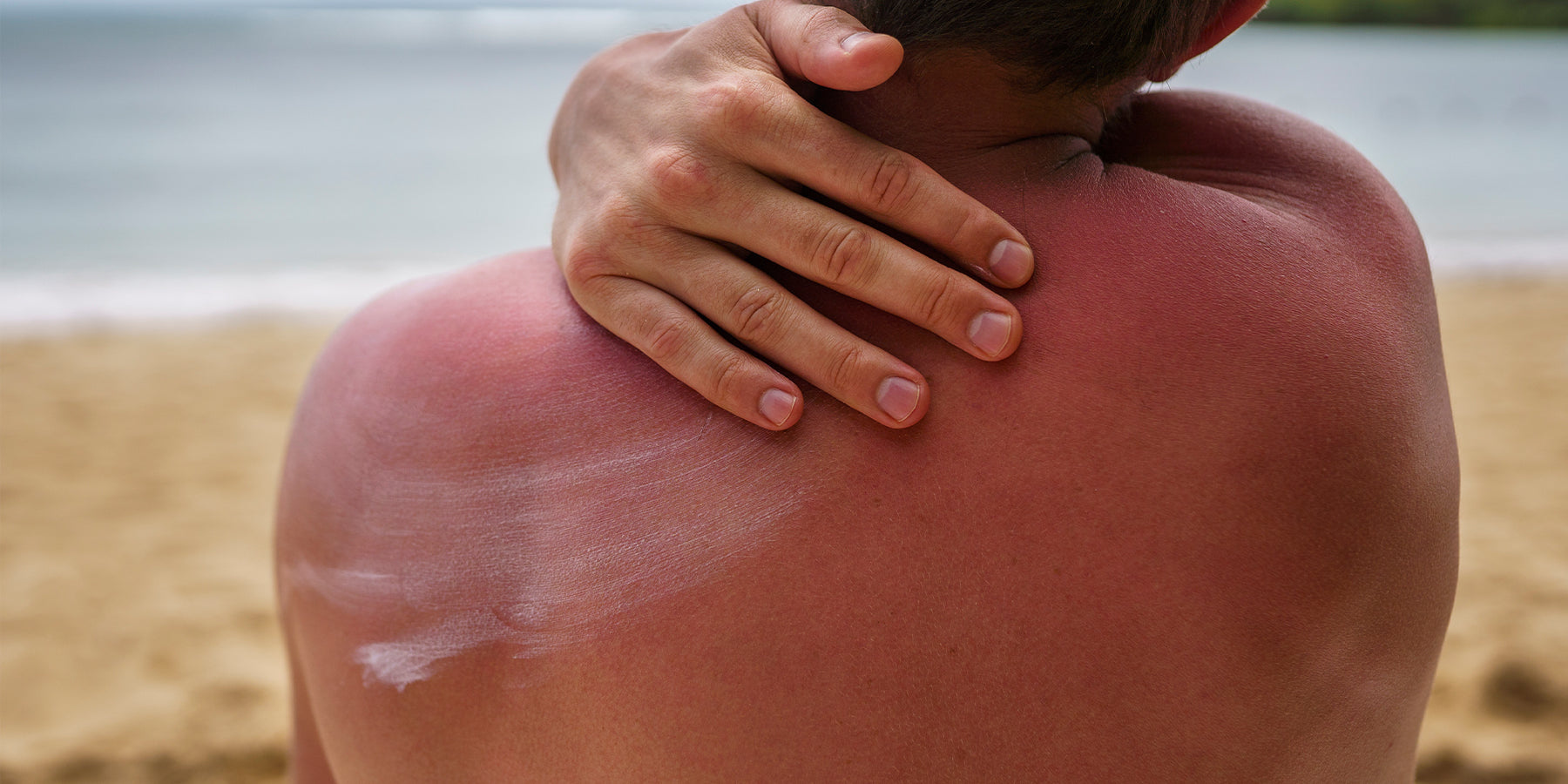 What Is a Sunburn? Unraveling the Science Behind Skin Damage and Prevention